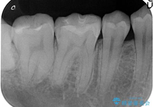セラミックインレー　気になる銀歯を白い歯への治療後