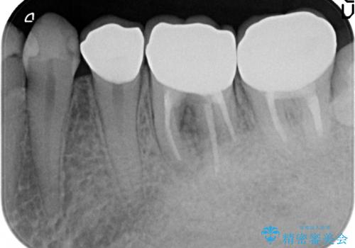 オールセラミッククラウン　治らない歯茎の腫れの治療後