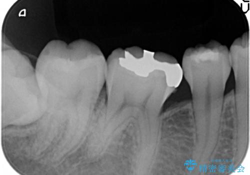セラミックインレー　銀歯から白い歯への治療前