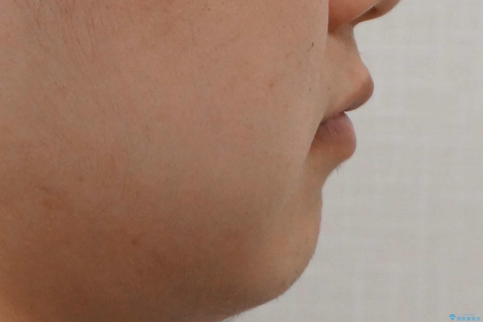 すきっ歯・出っ歯が気になる インビザライン矯正 乳歯をインプラントにの治療後(顔貌)