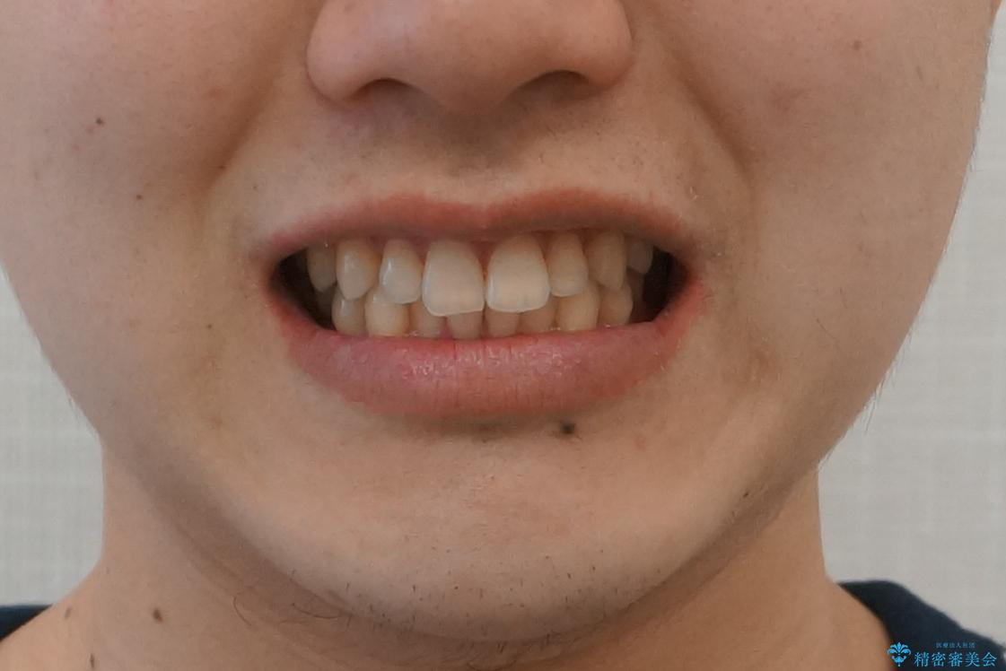 すきっ歯・出っ歯が気になる インビザライン矯正 乳歯をインプラントにの治療後(顔貌)