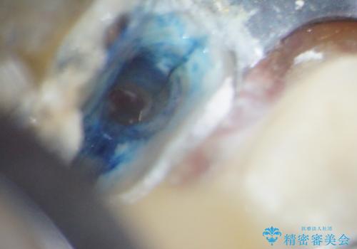 割れてしまった小臼歯 インプラントによる補綴治療の治療前