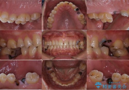 短期間で集中的に全顎治療の症例 治療前