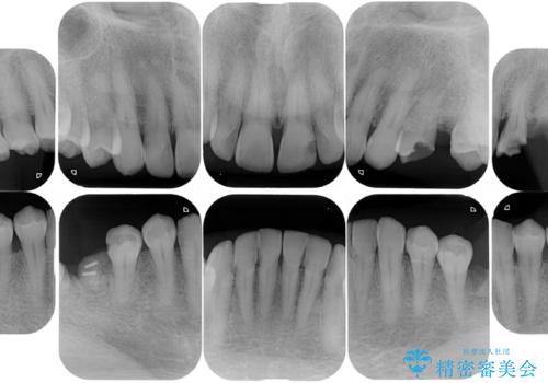 短期間で集中的に全顎治療の治療前