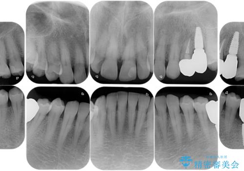 短期間で集中的に全顎治療の治療後