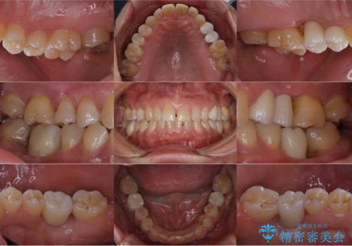 短期間で集中的に全顎治療の症例 治療後