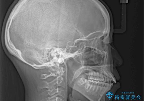 抜歯矯正の後戻り インビザラインによるオープンバイトの再矯正の治療前