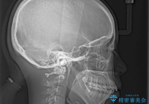 口元の突出感を改善 ワイヤー装置による抜歯矯正の治療前