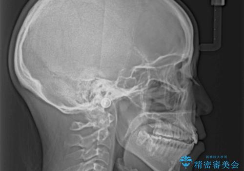 抜歯矯正の後戻り インビザラインによるオープンバイトの再矯正の治療後