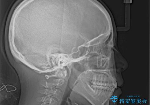 口元の突出感を改善 ワイヤー装置による抜歯矯正の治療後