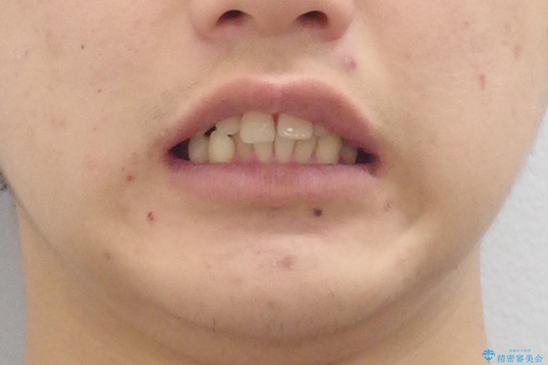 すきっ歯・出っ歯が気になる インビザライン矯正 乳歯をインプラントにの治療前(顔貌)