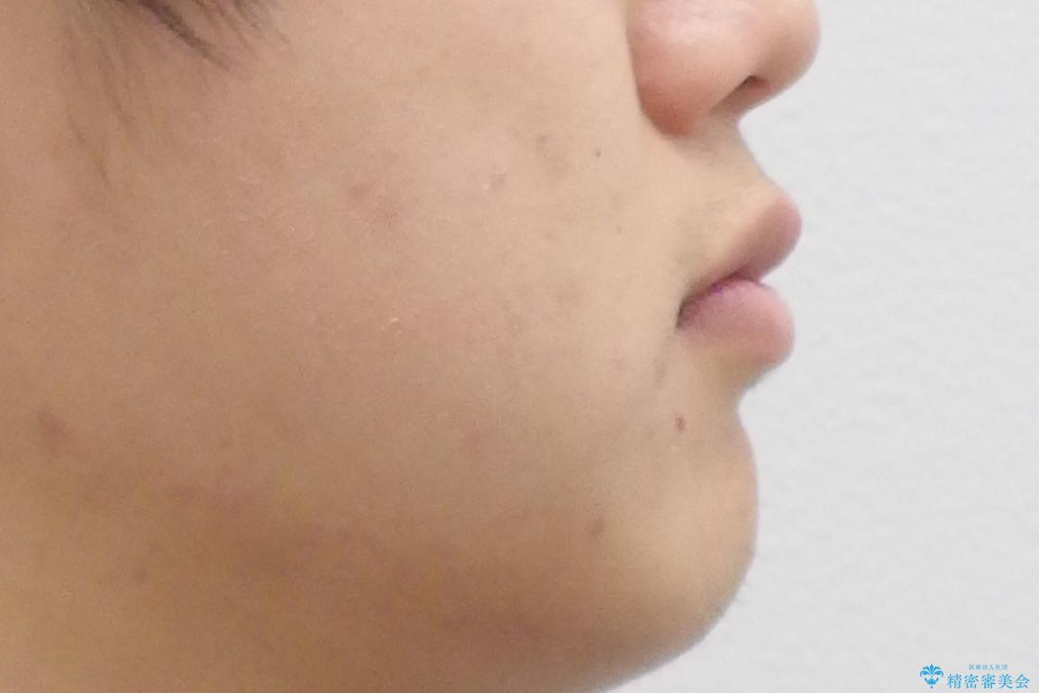 すきっ歯・出っ歯が気になる インビザライン矯正 乳歯をインプラントにの治療前(顔貌)