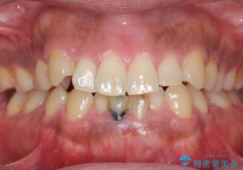 下の前歯の色が気になる セラミックで綺麗に 40代男性の治療前