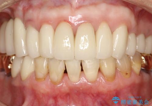 セラミックを入れた後もPMTCで定期的にメンテナンスの治療後