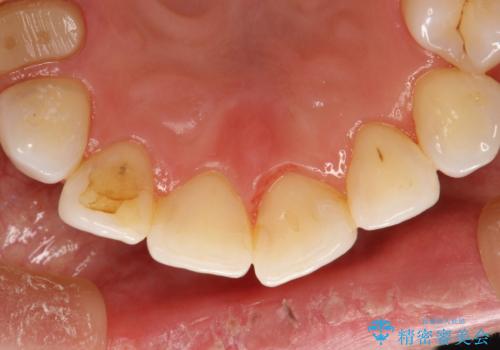 マスクにより感じる口臭をPMTCで対策の治療後