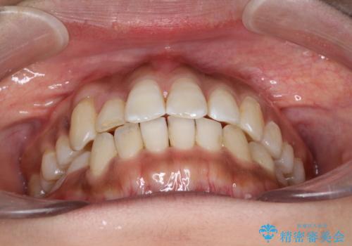 インビザラインと補助装置の併用による八重歯の抜歯矯正の治療後