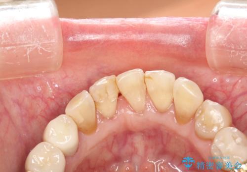 セラミックを入れた後もPMTCで定期的にメンテナンスの治療後