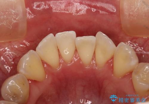 マスクにより感じる口臭をPMTCで対策の治療後