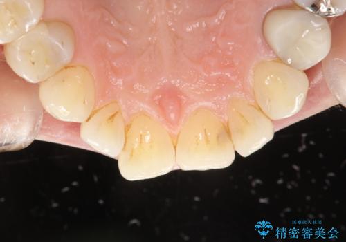 PMTCで歯と歯の間の細かいステインの除去の治療前