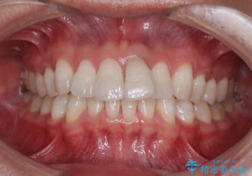 前歯のデコボコを治したい インビザラインによる矯正治療の症例 治療前