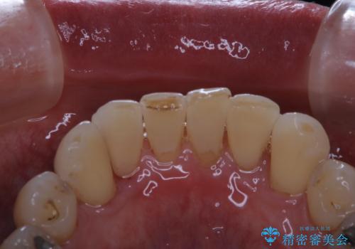 マウスピース矯正(インビザライン)中にコーヒの頑固な着色落としをPMTCでの治療後