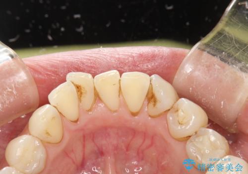 PMTCで歯と歯の間の細かいステインの除去の治療前