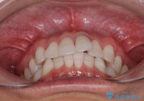 前歯のデコボコを治したい インビザラインによる矯正治療の治療前