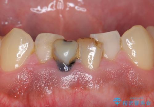 下の前歯の色が気になる セラミックで綺麗に 40代男性の治療前