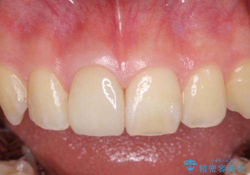 銀歯を白くしたい セラミックによる審美歯科治療の治療後