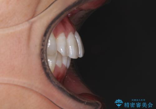 前歯のデコボコを治したい インビザラインによる矯正治療の治療前