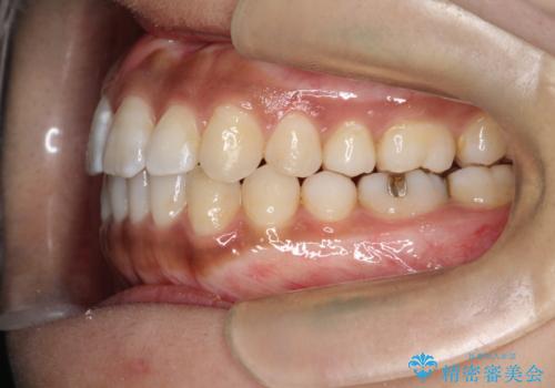 インビザラインと補助装置の併用による八重歯の抜歯矯正の治療後