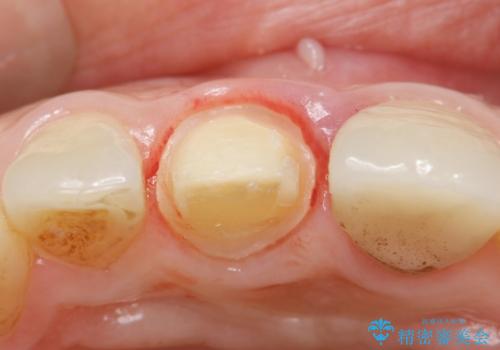 歯が折れた セラミックで綺麗に 30代女性の治療中