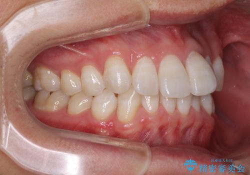 前歯のデコボコを治したい　インビザラインによる矯正治療の治療前