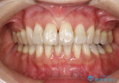 PMTCで舌ざわりをツルツルにの治療前