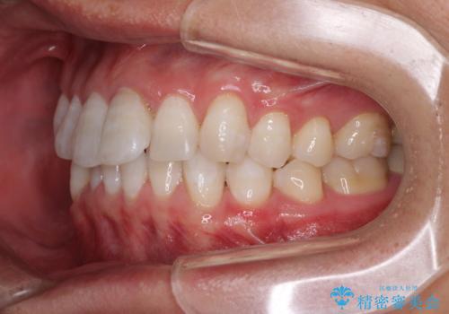 前歯のデコボコを治したい インビザラインによる矯正治療の治療前