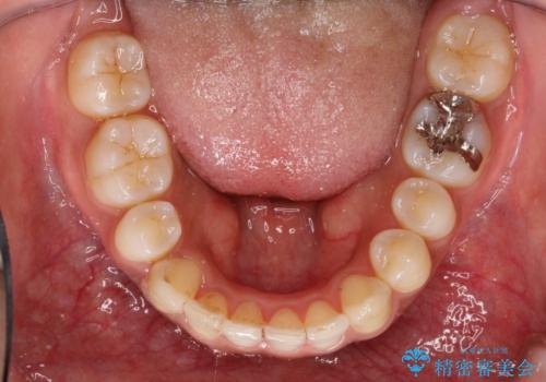 インビザラインと補助装置の併用による八重歯の抜歯矯正の治療後