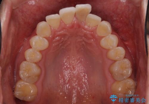 前歯のデコボコを治したい インビザラインによる矯正治療の治療前