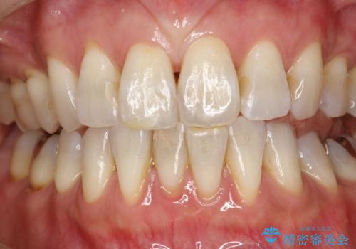 PMTCで舌ざわりをツルツルにの症例 治療前