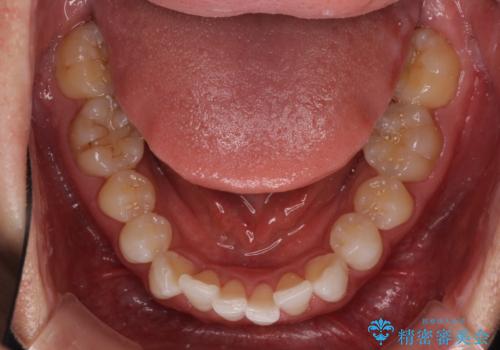 前歯のデコボコを治したい インビザラインによる矯正治療の治療前