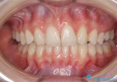 上顎前歯が2本欠損 インビザラインによる叢生の解消の治療中