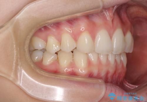 上顎前歯が2本欠損 インビザラインによる叢生の解消の治療中