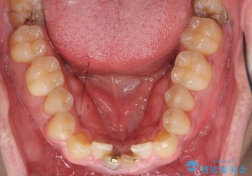 下の前歯の色が気になる セラミックで綺麗に 40代男性の治療前