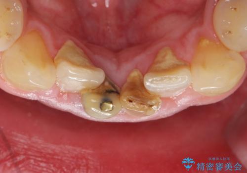下の前歯の色が気になる セラミックで綺麗に 40代男性の治療前