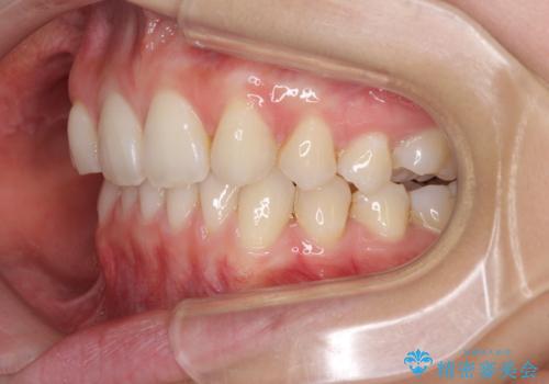 上顎前歯が2本欠損　インビザラインによる叢生の解消の治療中