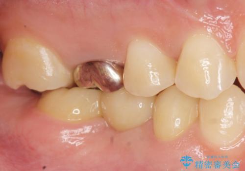 部分矯正を併用したブリッジ治療の症例 治療後