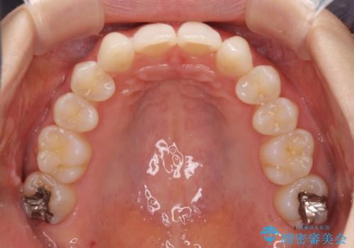 上顎前歯が2本欠損　インビザラインによる叢生の解消の治療中