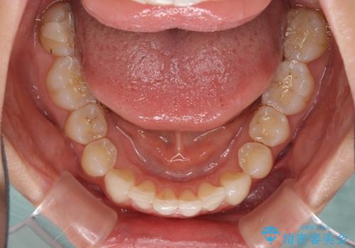 上顎前歯が2本欠損 インビザラインによる叢生の解消の治療中