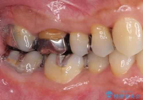 痛くてかめない 根管治療とオールセラミッククラウンの治療前