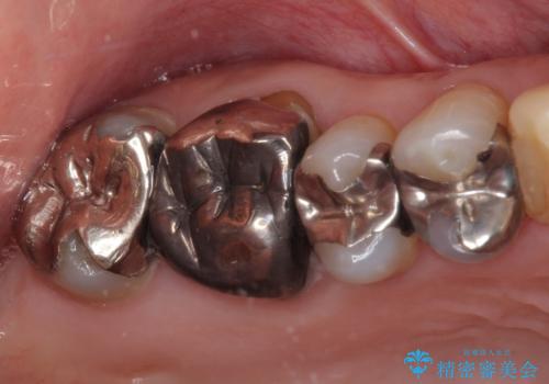 痛くてかめない 根管治療とオールセラミッククラウンの治療前