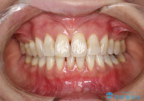 PMTCで舌ざわりをツルツルにの治療後